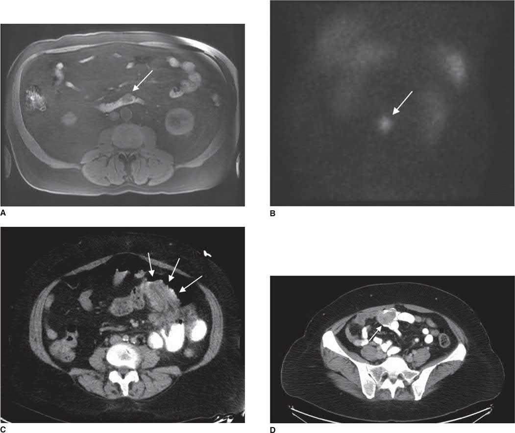 Imaging of small bowel tumours: MRI showing an intraluminal filling defect in the duodenum