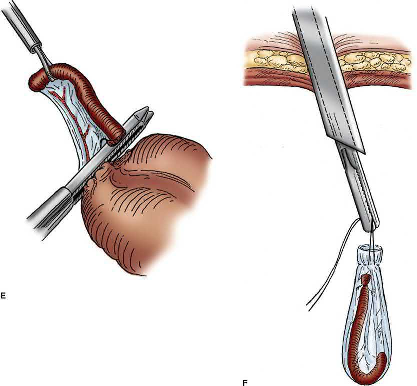 Laparoscopic appendicectomy technique: patient positioning, port placement and creation of the pneumoperitoneum
