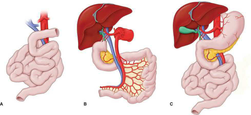 Jejunoileal graft procured with its vascular pedicle