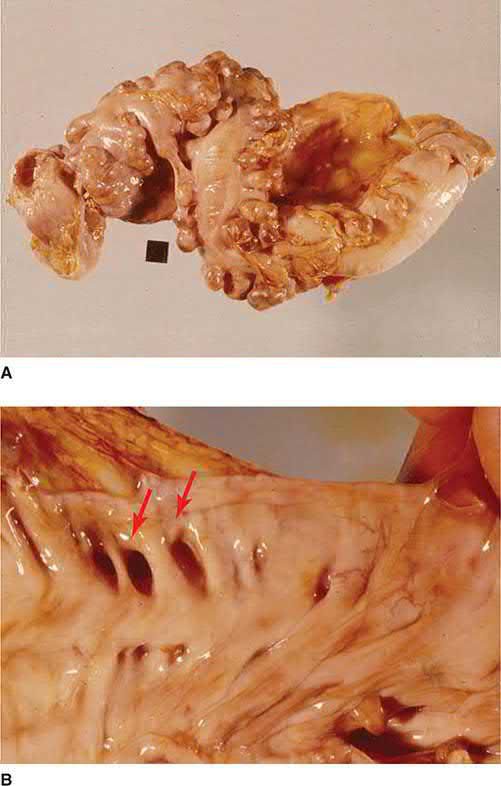 A. Resected sigmoid colon studded with diverticula. B. Mucosal view showing the diverticular openings between the taeniae
