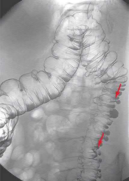 Left colonic diverticula demonstrated on double-contrast barium enema (arrows)