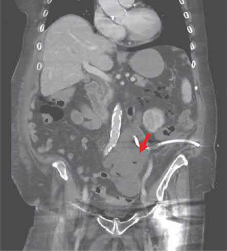 Sigmoid diverticulitis complicated by a paracolic abscess, with a percutaneous drainage tube in situ (arrow)