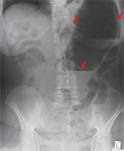 Caecal volvulus with proximal small bowel obstruction on plain abdominal radiograph