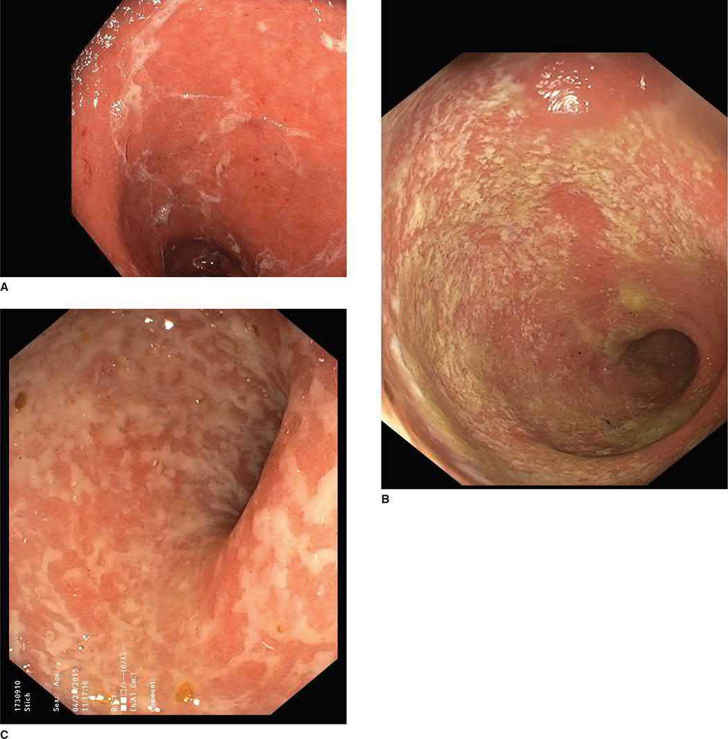 Endoscopic appearances of ulcerative colitis. A. Mild disease. B. Moderate disease. C. Severe disease, with the mucosa covered by white exudative granularity