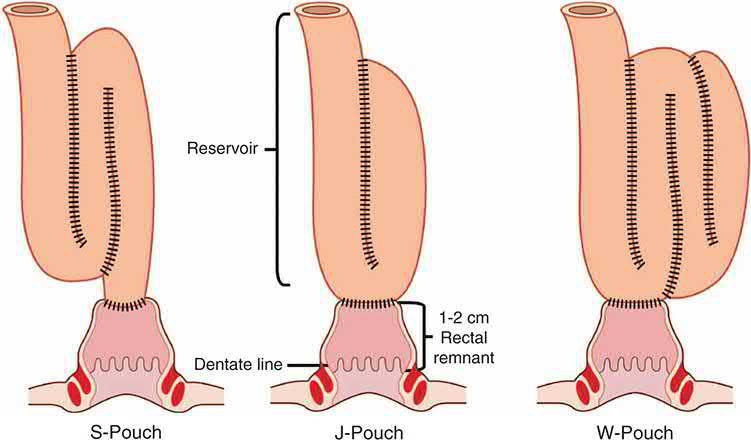 S, J and W ileal pouch configurations for restorative proctocolectomy, showing the reservoir, the 1-2 cm rectal remnant and the dentate line