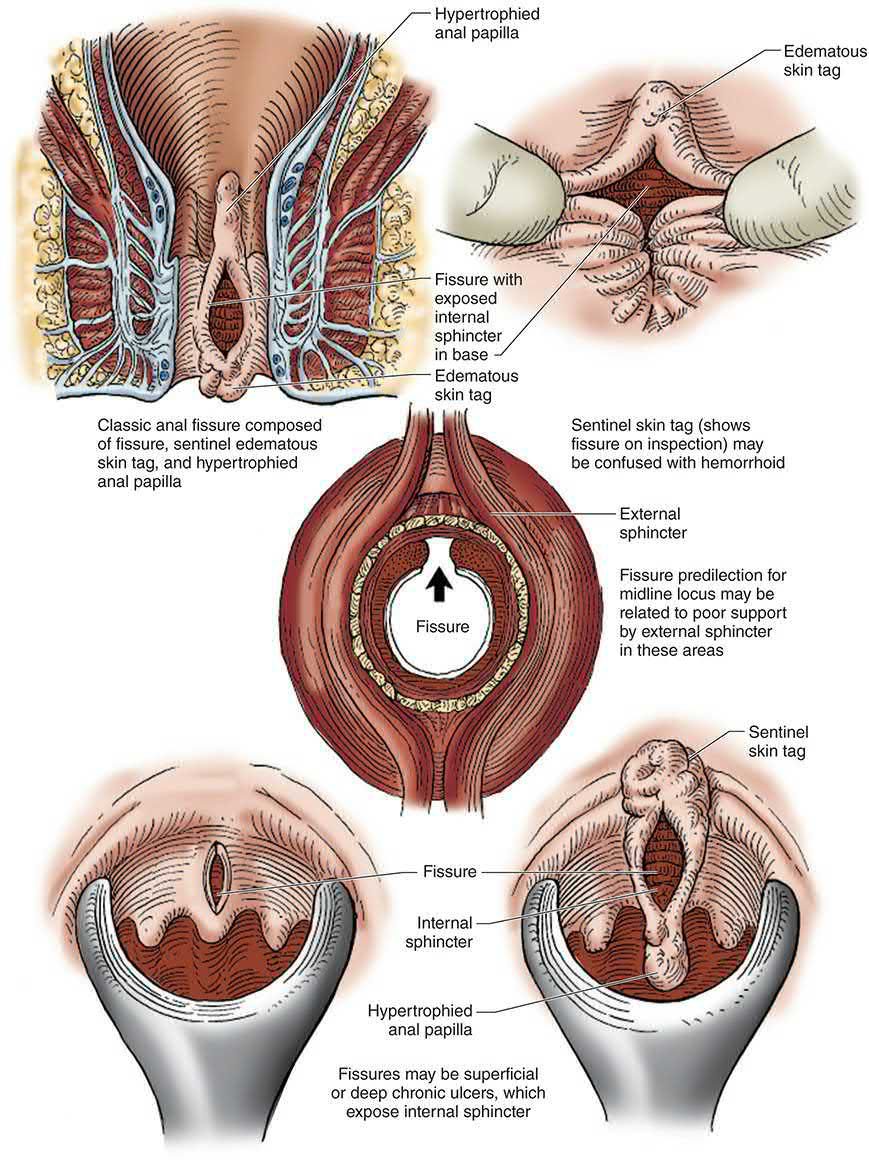 Anal fissure: the classic triad of fissure, sentinel oedematous skin tag and hypertrophied anal papilla, and the midline predilection related to poor external sphincter support