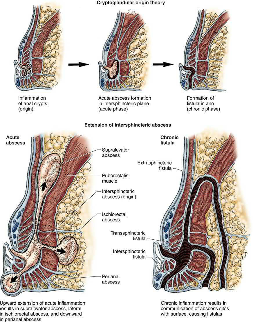 Cryptoglandular origin theory of anorectal abscess and fistula-in-ano, with the routes of extension of an intersphincteric abscess and the resulting fistula types