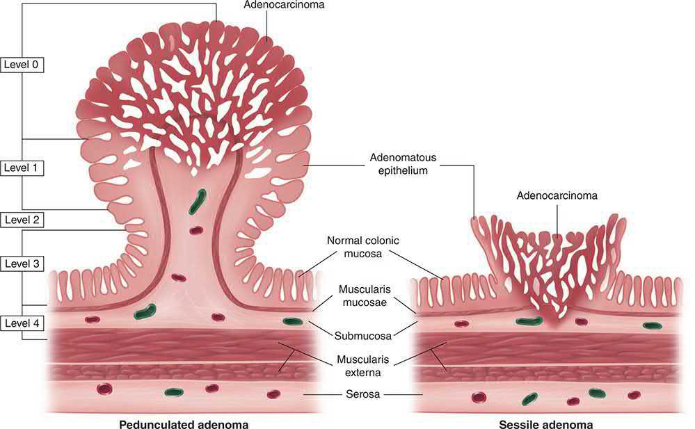 Haggitt levels of invasion for a pedunculated and a sessile adenoma each containing invasive carcinoma, referenced to the mucosa, muscularis mucosae and submucosa