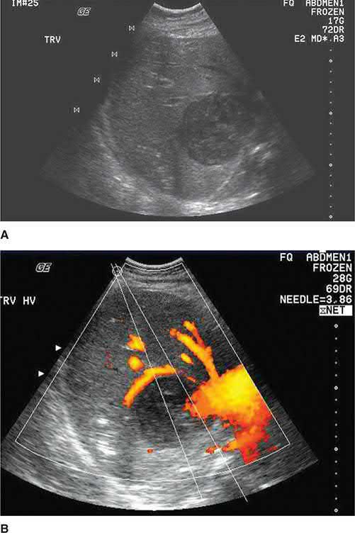 Abdominal ultrasound of a pyogenic liver abscess