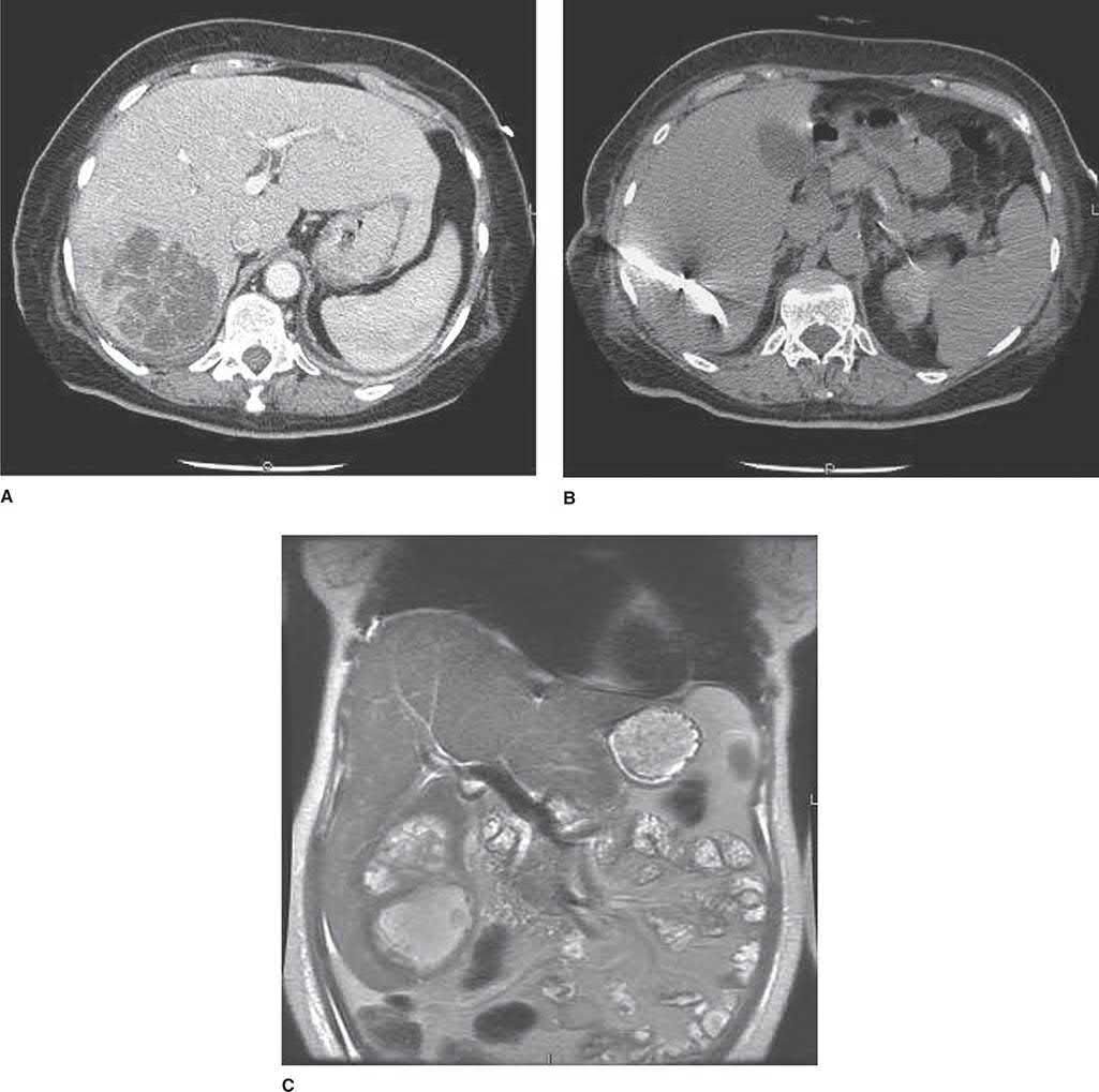 A large low-density pyogenic liver abscess on CT, and its percutaneous drainage
