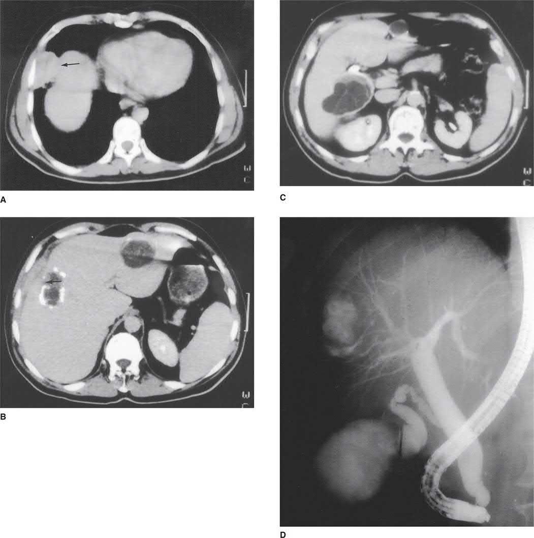CT showing rupture of a hydatid cyst through the diaphragm