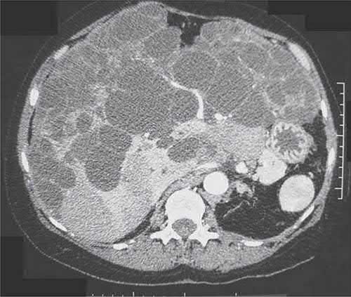 Computed tomography demonstrating polycystic liver disease
