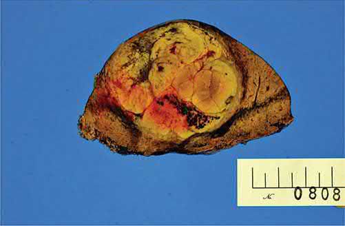 Gross pathological specimen of a massive hepatocellular carcinoma
