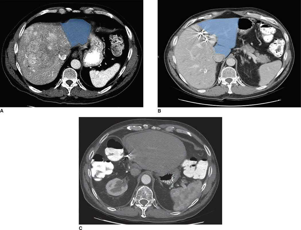 Right portal vein embolisation for large hepatocellular carcinoma: future liver remnant (blue) before (A) and after (B) embolisation, then after right hepatectomy (C)