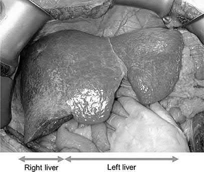 Intraoperative view of a cirrhotic liver demarcated along the Cantlie line before right hepatectomy for hepatocellular carcinoma