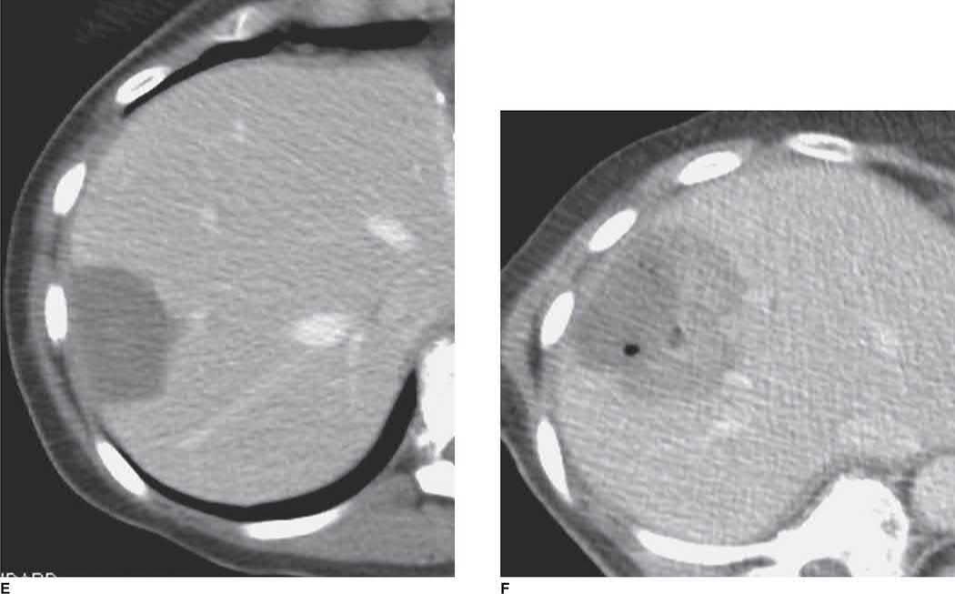 Cross-sectional imaging after microwave ablation of colorectal liver metastases, showing successful ablation zones for the peripheral (E) and more central (F) lesions