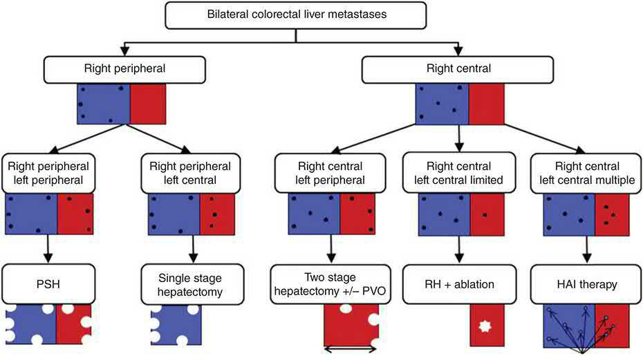 Systematic algorithm for assessing the distribution and extent of bilateral colorectal liver metastases, guiding parenchymal-sparing hepatectomy, two-stage hepatectomy, ablation or HAI therapy