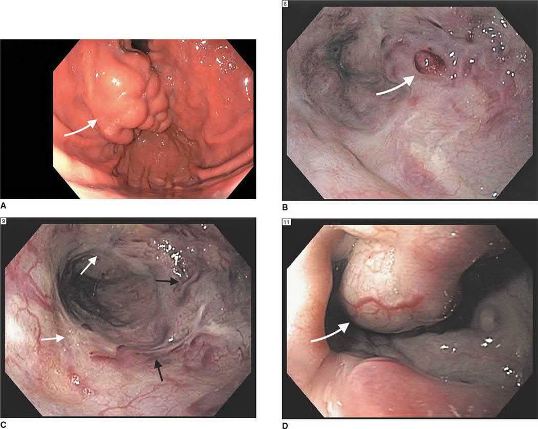 Endoscopic appearances: fundal gastric varices (A), oesophageal varices with cherry red spot (B), post-band scarring with red wale signs (C), large varices (D)