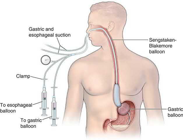 The Sengstaken-Blakemore tube for tamponade of the distal oesophagus and gastric fundus, showing the gastric and oesophageal balloons and the suction ports