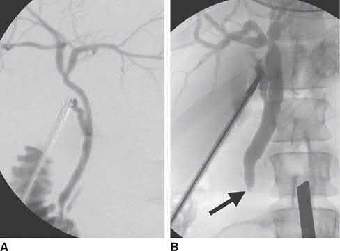 Intraoperative cholangiogram images: A, a normal cholangiogram; B, a cholangiogram revealing a meniscus sign (arrow) and lack of duodenal filling from choledocholithiasis