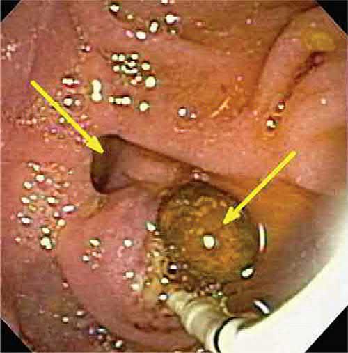 Endoscopic retrograde cholangiopancreatography (ERCP) with common bile duct stone extraction through the sphincterotomy (arrows)