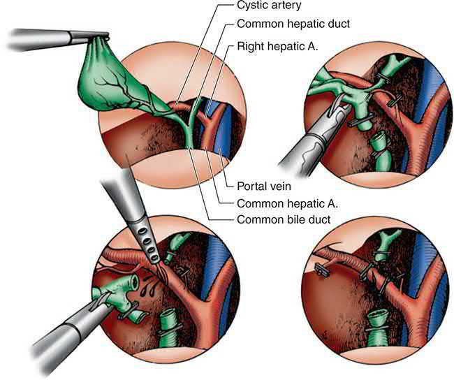 The classic laparoscopic bile duct injury: the common bile duct is mistaken for the cystic duct and is clipped and divided