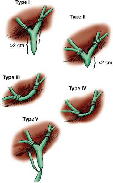 Bismuth classification of bile duct strictures by the level of the stricture relative to the confluence of the hepatic ducts; types III-V are complex injuries