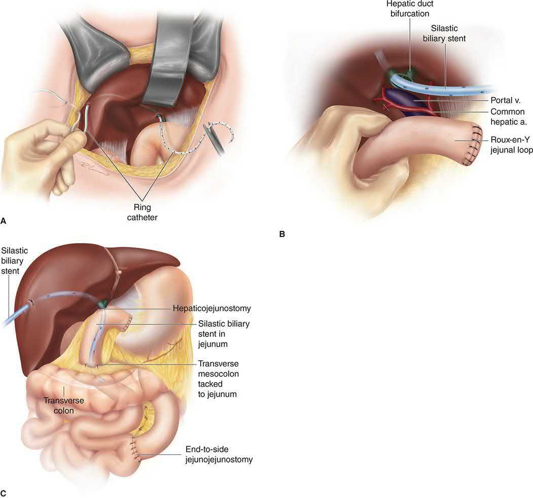 Roux-en-Y hepaticojejunostomy reconstruction of the biliary tree