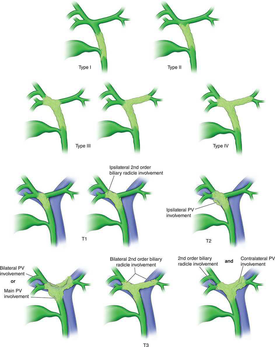 The Bismuth-Corlette classification and the MSKCC staging system for perihilar cholangiocarcinoma