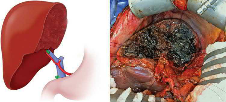 Liver after resection of a Klatskin tumour with left hepatectomy and caudate resection: illustration (left) and intraoperative photograph (right) of the remnant