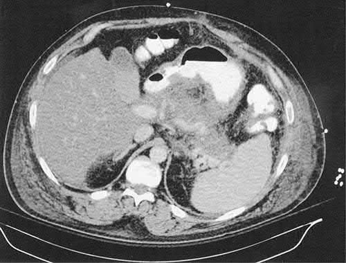 Contrast-enhanced CT showing peripancreatic fat stranding with near-complete absence of pancreatic enhancement, diagnostic of pancreatic necrosis