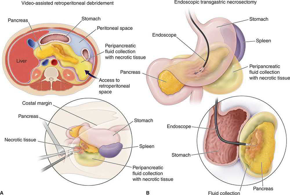 Cross-sectional views depicting video-assisted retroperitoneal debridement of infected walled-off necrosis (A) and endoscopic transgastric drainage and necrosectomy (B)