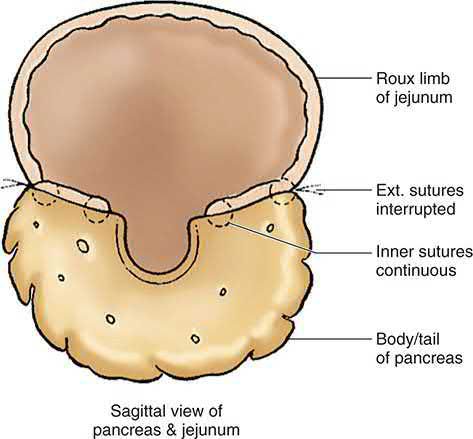 Cross-section of the anastomosis for a lateral pancreaticojejunostomy (applies to the Puestow, Frey or Izbicki procedures)