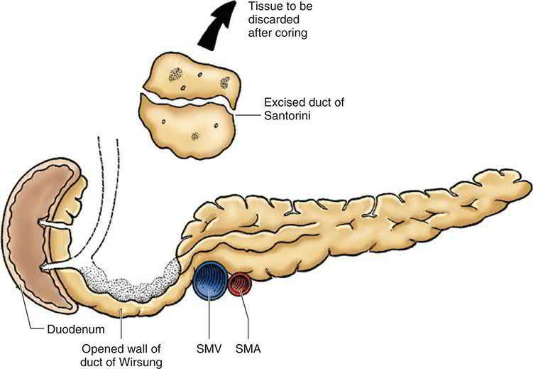 Cross-sectional drawing of the pancreas following coring of the pancreatic head during a Frey procedure