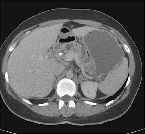 Hereditary chronic pancreatitis associated with a PRSS1 gene mutation, showing pancreatic calcification