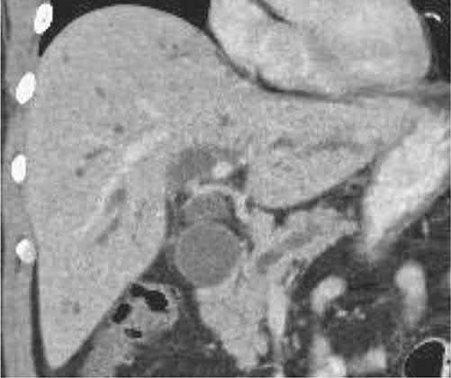 Computed tomography showing the double duct sign, with a dilated common and intrahepatic biliary system and a dilated main pancreatic duct