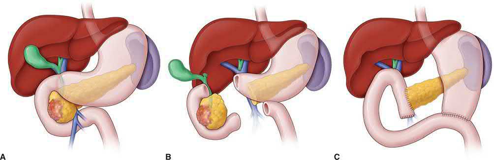 Whipple operation: (A) lines of transection; (B) specimen removed at pancreaticoduodenectomy; (C) reconstruction with pancreatico-, choledocho- and gastrojejunostomy
