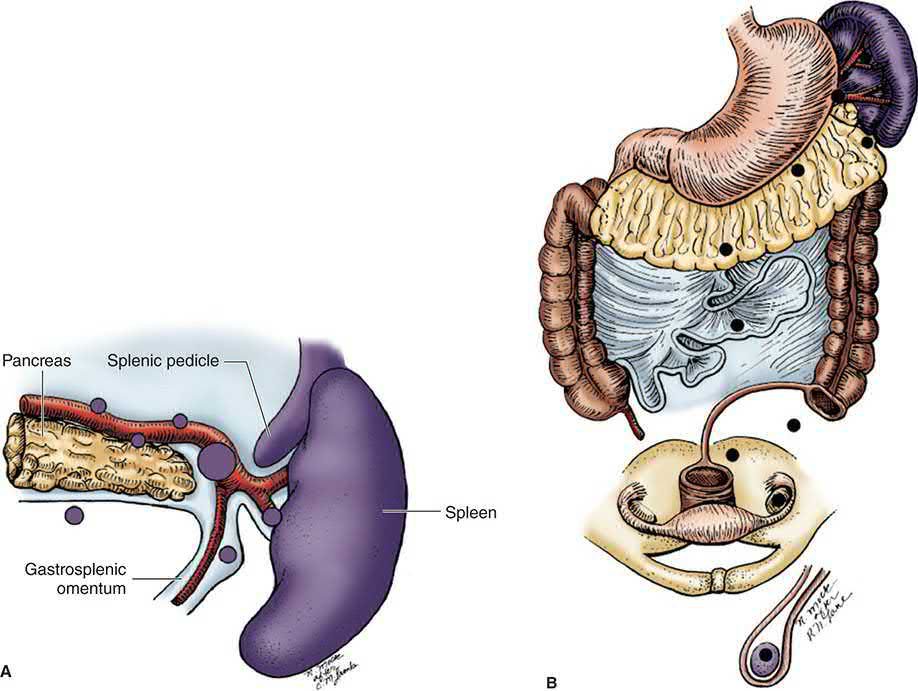 The common locations of accessory spleens, which must be sought and removed or haematological disease will persist