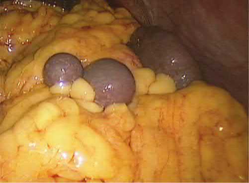 Two small splenules in the greater omentum adjacent to the spleen