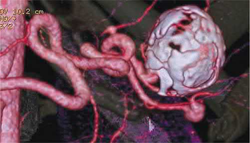 Three-dimensional CT reconstruction of a partially thrombosed splenic artery aneurysm
