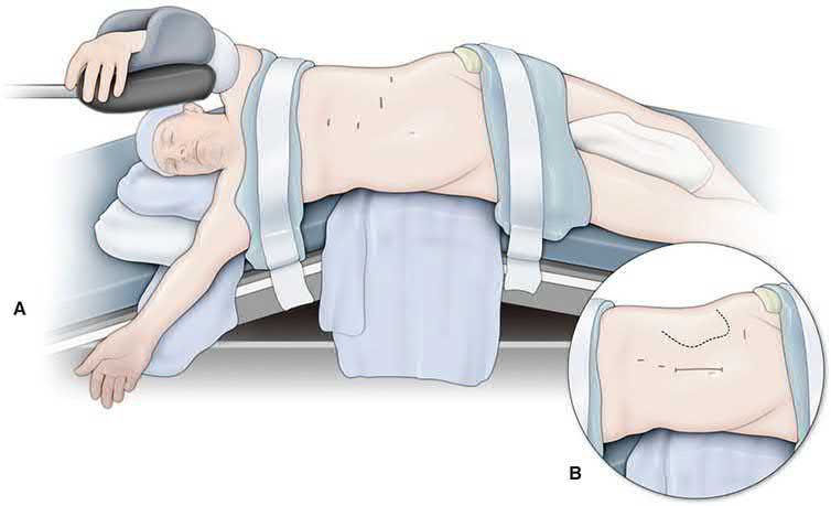 Patient and trocar positioning for laparoscopic splenectomy: right lateral decubitus with the table flexed; inset shows recommended port placement