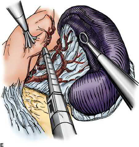 Step of laparoscopic splenectomy: division of the splenic hilum using an endoscopic stapler