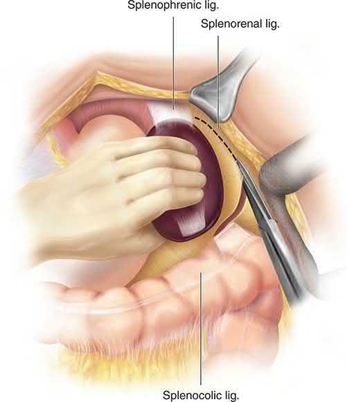 Division of the ligamentous attachments of the spleen at open splenectomy