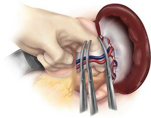 Division of the splenic hilum using the three-clamp method of Federoff
