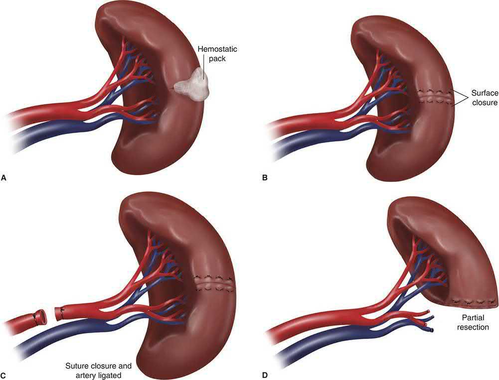 Approaches to preserving a traumatised spleen: haemostatic packing, surface closure, suture closure with arterial ligation, and partial resection