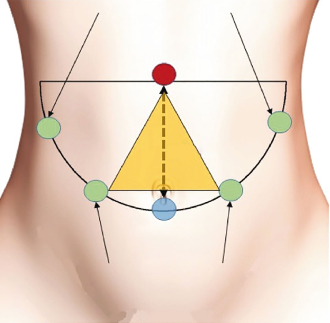 Ergonomic port placement: retracting ports far laterally, the optical port centrally for visual access, and the working ports between them to ensure good instrument mobility