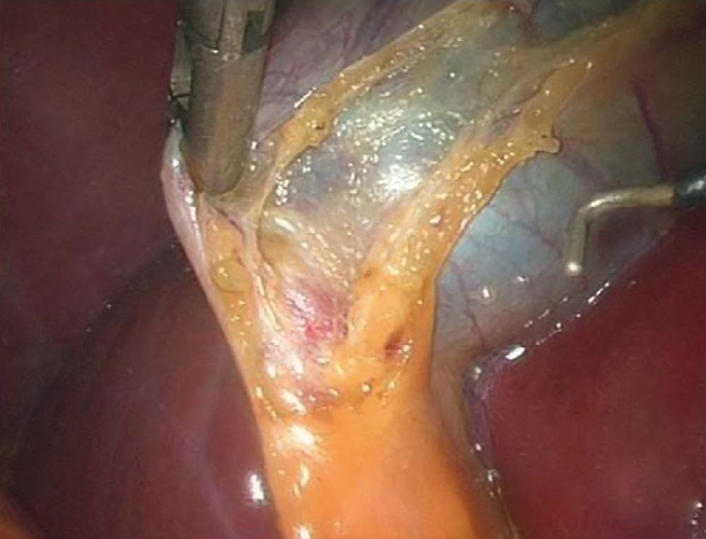 Calot's triangle during laparoscopic cholecystectomy