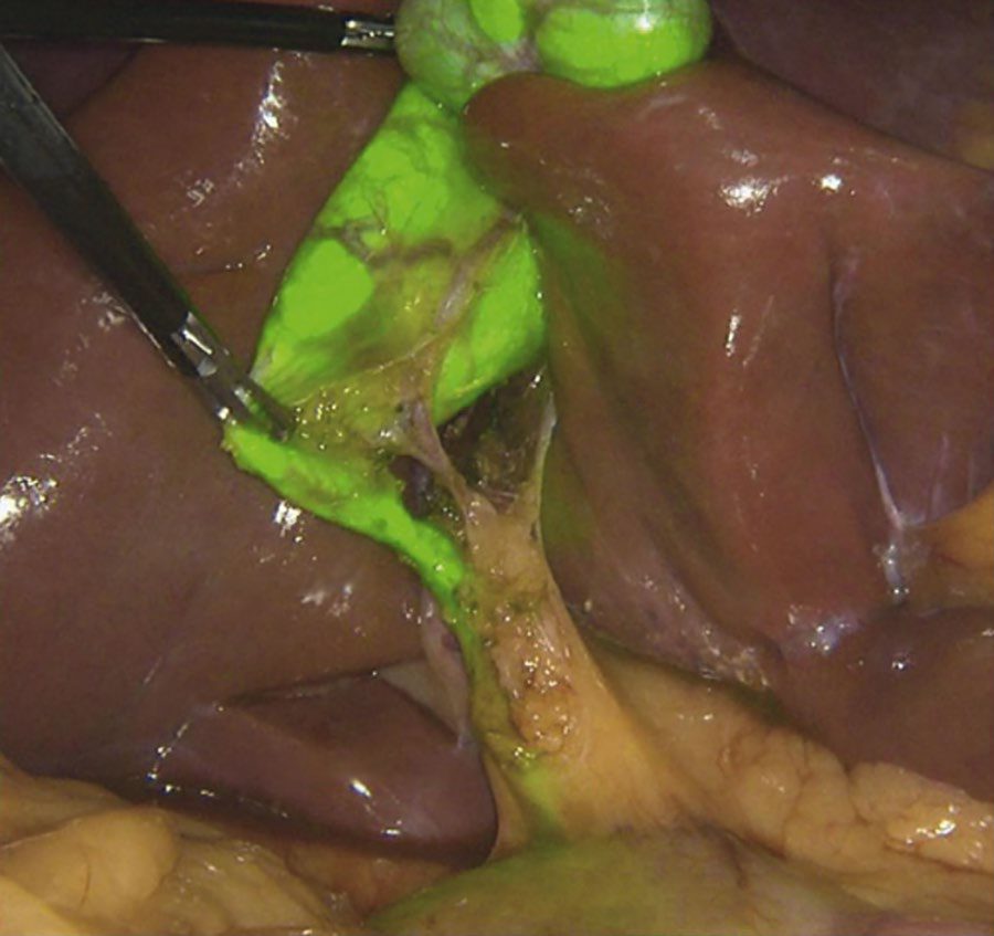 The critical view of safety during laparoscopic cholecystectomy
