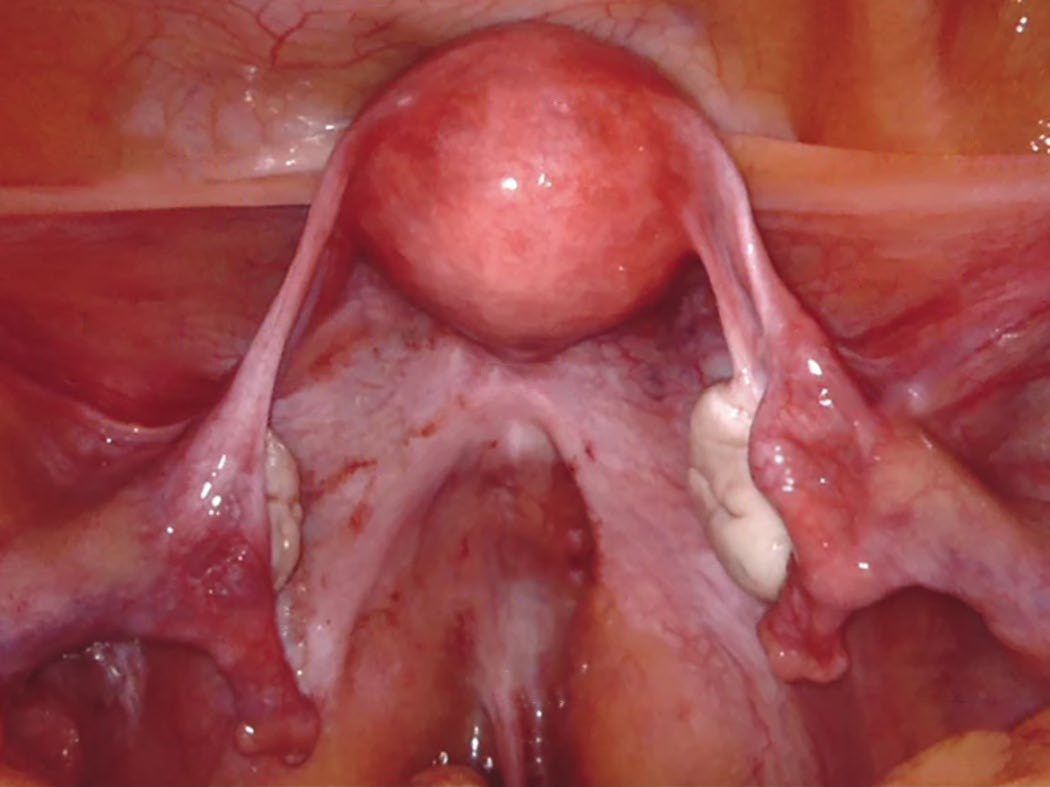 Normal female pelvic anatomy seen laparoscopically