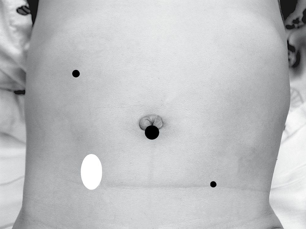Port location for laparoscopic orchiopexy is seen on the right; the approximate position of the intra-abdominal testis is also depicted